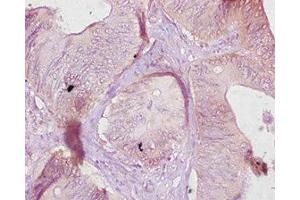 Immunohistochemistry of paraffin-embedded human colon cancer using ABIN7177073 at dilution of 1:10 (CES1C antibody  (AA 19-550))