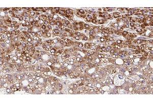 ABIN6279842 at 1/100 staining Human liver cancer tissue by IHC-P. (SLC10A4 antibody  (C-Term))
