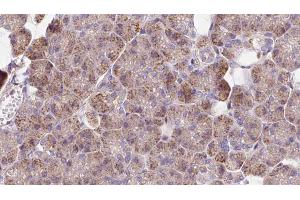 ABIN6273272 at 1/100 staining Human pancreas cancer tissue by IHC-P. (NCKAP1 antibody  (Internal Region))