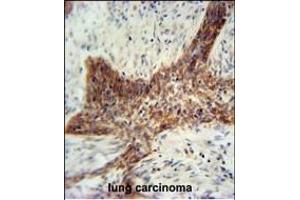 RILPL2 antibody (Center) (ABIN654981 and ABIN2844621) immunohistochemistry analysis in formalin fixed and paraffin embedded human lung carcinoma followed by peroxidase conjugation of the secondary antibody and DAB staining. (RILPL2 antibody  (AA 120-149))