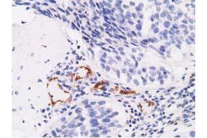 Immunohistochemical staining of paraffin-embedded Carcinoma of Human bladder tissue using anti-AFP mouse monoclonal antibody. (alpha Fetoprotein antibody)