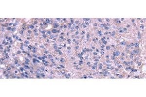 Immunohistochemistry of paraffin-embedded Human breast cancer using TRIM14 Polyclonal Antibody at dilution of 1/35 (TRIM14 antibody)