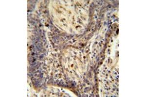 Formalin fixed and paraffin embedded human lung carcinoma reacted with PPRC1 Antibody (C-term) followed by peroxidase conjugation of the secondary antibody and DAB staining. (PPRC1 antibody  (C-Term))