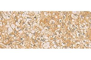 Immunohistochemistry of paraffin-embedded Human liver cancer tissue using FAAP100 Polyclonal Antibody at dilution of 1:50(x200) (C17orf70 antibody)