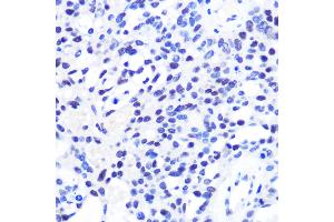 Immunohistochemistry of paraffin-embedded Human oophoroma using CHD4 antibody (ABIN6127308, ABIN6138512, ABIN6138513 and ABIN6215263) at dilution of 1:100 (40x lens). (CHD4 antibody  (AA 1520-1690))