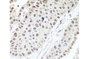 Immunohistochemistry of paraffin-embedded Human lung cancer using ALKBH4 Polyclonal Antibody at dilution of 1:100 (40x lens).