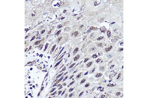 Immunohistochemistry of paraffin-embedded human esophageal cancer using CUX1 antibody (ABIN1679438, ABIN3015866, ABIN3015867 and ABIN6219446) at dilution of 1:200 (40x lens). (CUX1 antibody  (AA 1-280))