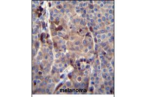 PREF8 Antibody (C-term) (ABIN656145 and ABIN2845481) immunohistochemistry analysis in formalin fixed and paraffin embedded human melanoma tissue followed by peroxidase conjugation of the secondary antibody and DAB staining. (PRAMEF8 antibody  (C-Term))