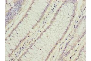 Immunohistochemistry of paraffin-embedded human colon cancer using ABIN7165562 at dilution of 1:100