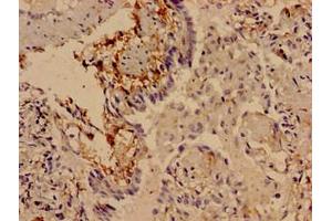 Immunocytochemistry analysis of human lung cancer using ABIN7169803 at dilution of 1:100 (SLITRK5 antibody  (AA 617-890))