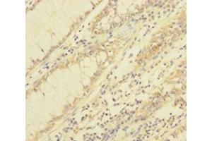 Immunohistochemistry of paraffin-embedded human colon cancer using ABIN7172031 at dilution of 1:100 (TXNL1 antibody  (AA 2-289))