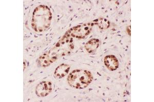 Anti-APE1 Picoband antibody,  IHC(P): Human Lung Cancer Tissue (APEX1 antibody  (AA 2-318))