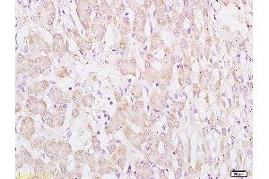 Formalin-fixed and paraffin embedded human hepatocellular carcinoma labeled with Anti WDR16 Polyclonal Antibody, Unconjugated (ABIN720865) at 1:200 followed by conjugation to the secondary antibody and DAB staining (WDR16 antibody  (AA 401-500))