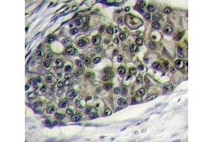 IHC analysis of FFPE human breast carcinoma tissue stained with LRP6 antibody (LRP6 antibody  (AA 1531-1560))