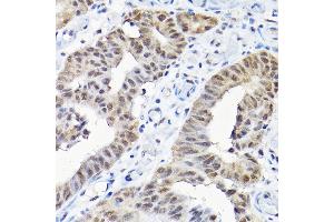 Immunohistochemistry of paraffin-embedded human colon carcinoma using SNRPF Rabbit pAb (ABIN6132678, ABIN6148228, ABIN6148229 and ABIN6215753) at dilution of 1:200 (40x lens). (SNRPF antibody  (AA 1-86))