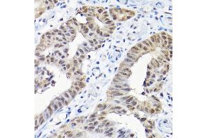 Immunohistochemistry of paraffin-embedded human colon carcinoma using SNRPF Rabbit pAb (ABIN6132678, ABIN6148228, ABIN6148229 and ABIN6215753) at dilution of 1:200 (40x lens). (SNRPF antibody  (AA 1-86))