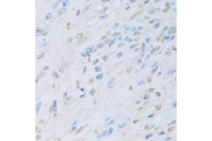 Immunohistochemistry of paraffin-embedded human liver cancer using KAT2A antibody. (KAT2A antibody)