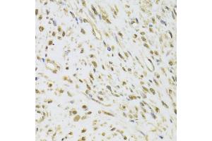 Immunohistochemistry of paraffin-embedded human leiomyoma of uterus using DDX1 Antibody (ABIN5973950) at dilution of 1/100 (40x lens). (DDX1 antibody)