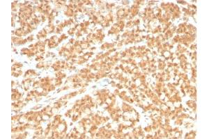 Formalin-fixed, paraffin-embedded human Colon Carcinoma stained with ICOSL-Monospecific Mouse Monoclonal Antibody (ICOSL/3260). (ICOSLG antibody  (AA 23-149))