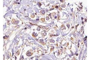 ABIN6276874 at 1/100 staining Human breast cancer tissue by IHC-P. (HMBS antibody  (Internal Region))