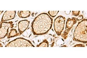 Immunohistochemistry of paraffin-embedded Human thyroid cancer tissue using LRRC2 Polyclonal Antibody at dilution of 1:55(x200) (LRRC2 antibody)