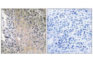 Immunohistochemistry analysis of paraffin-embedded human lung carcinoma tissue using RAB41 antibody. (RAB41 antibody  (Internal Region))