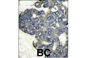 Formalin-fixed and paraffin-embedded human breast carcinoma reacted with PI3KCD Antibody (N-term) (ABIN392564 and ABIN2842107) , which was peroxidase-conjugated to the secondary antibody, followed by DAB staining. (PIK3CD antibody  (N-Term))