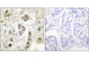 Immunohistochemistry analysis of paraffin-embedded human lung carcinoma tissue, using HSP60 Antibody. (HSPD1 antibody  (AA 511-560))