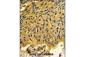Formalin-fixed and paraffin-embedded human lung carcinoma reacted with CDK2 Antibody (C-term), which was peroxidase-conjugated to the secondary antibody, followed by DAB staining.
