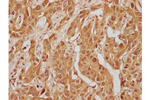 IHC image of ABIN7140235 diluted at 1:300 and staining in paraffin-embedded human liver cancer performed on a Leica BondTM system.