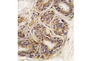 Formalin-fixed and paraffin-embedded human breast carcinoma tissue reacted with CASC3 Antibody , which was peroxidase-conjugated to the secondary antibody, followed by DAB staining. (CASC3 antibody  (Tyr181))
