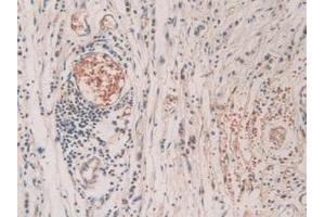 IHC-P analysis of Human Stomach Cancer Tissue, with DAB staining. (SHC3 antibody  (AA 188-433))