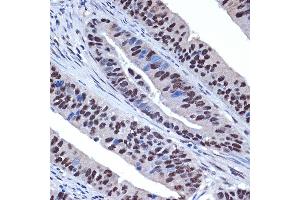 Immunohistochemistry of paraffin-embedded human colon carcinoma using WDR4 Rabbit mAb (ABIN7271355) at dilution of 1:100 (40x lens).