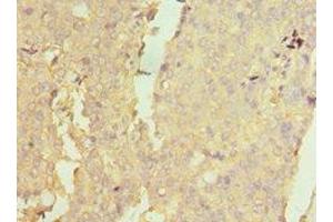 Immunohistochemistry of paraffin-embedded human colon cancer using ABIN7160732 at dilution of 1:100 (PTPDC1 antibody  (AA 161-235))