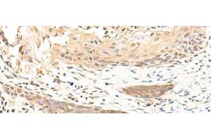 Immunohistochemistry of paraffin-embedded Human esophagus cancer tissue using RBM26 Polyclonal Antibody at dilution of 1:35(x200) (RBM26 antibody)