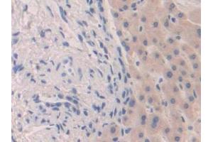 Detection of FGF19 in Human Liver cancer Tissue using Polyclonal Antibody to Fibroblast Growth Factor 19 (FGF19)