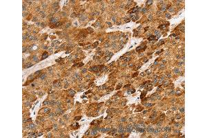 Immunohistochemistry of Human liver cancer using LTB Polyclonal Antibody at dilution of 1:45