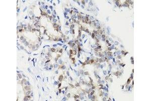 Immunohistochemistry of paraffin-embedded Human breast cancer using Phospho-Stat3(S727) Polyclonal Antibody at dilution of 1:100 (40x lens).