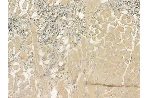 ABIN6264824 and ABIN6276917 at 1/100 staining human tongue carcinoma by IHC-P.