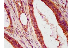 IHC image of ABIN7156667 diluted at 1:600 and staining in paraffin-embedded human colon cancer performed on a Leica BondTM system. (IFIT2 antibody  (AA 130-265))