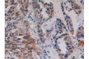 Detection of PKD1 in Human Breast Cancer Tissue using Polyclonal Antibody to Protein Kinase D1 (PKD1) (PKC mu antibody)