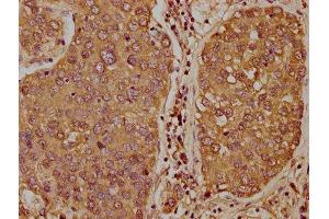 IHC image of ABIN7171357 diluted at 1:400 and staining in paraffin-embedded human liver cancer performed on a Leica BondTM system. (TCL1B antibody  (AA 1-128))