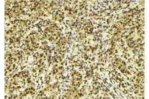 ABIN6279297 at 1/100 staining Human breast cancer tissue by IHC-P.