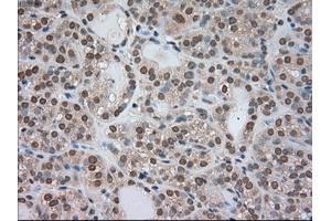 Immunohistochemical staining of paraffin-embedded Carcinoma of kidney tissue using anti-BUB1Bmouse monoclonal antibody. (BUB1B antibody)