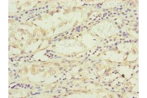 Immunohistochemistry of paraffin-embedded human gastric cancer using ABIN7159902 at dilution of 1:100 (TIMM17B antibody  (AA 1-172))