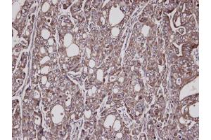 IHC-P Image Immunohistochemical analysis of paraffin-embedded NCI-N87 xenograft, using Lysyl-tRNA synthetase, antibody at 1:100 dilution. (KARS antibody)