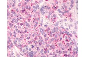 Anti-FKSG80 / GPR81 antibody IHC of human Ovary, Carcinoma. (GPR81 antibody  (Extracellular Domain))