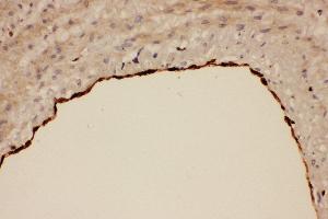 Anti-COX1 Picoband antibody,  IHC(P): Human Lung Cancer Tissue (PTGS1 antibody  (AA 318-599))