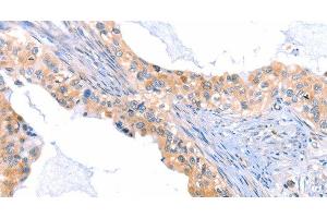 Immunohistochemistry of paraffin-embedded Human cervical cancer tissue using THBS1 Polyclonal Antibody at dilution 1:60 (Thrombospondin 1 antibody)