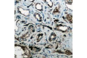 Immunohistochemical analysis of Aquaporin 4 staining in human lung cancer formalin fixed paraffin embedded tissue section. (Aquaporin 4 antibody  (Center))